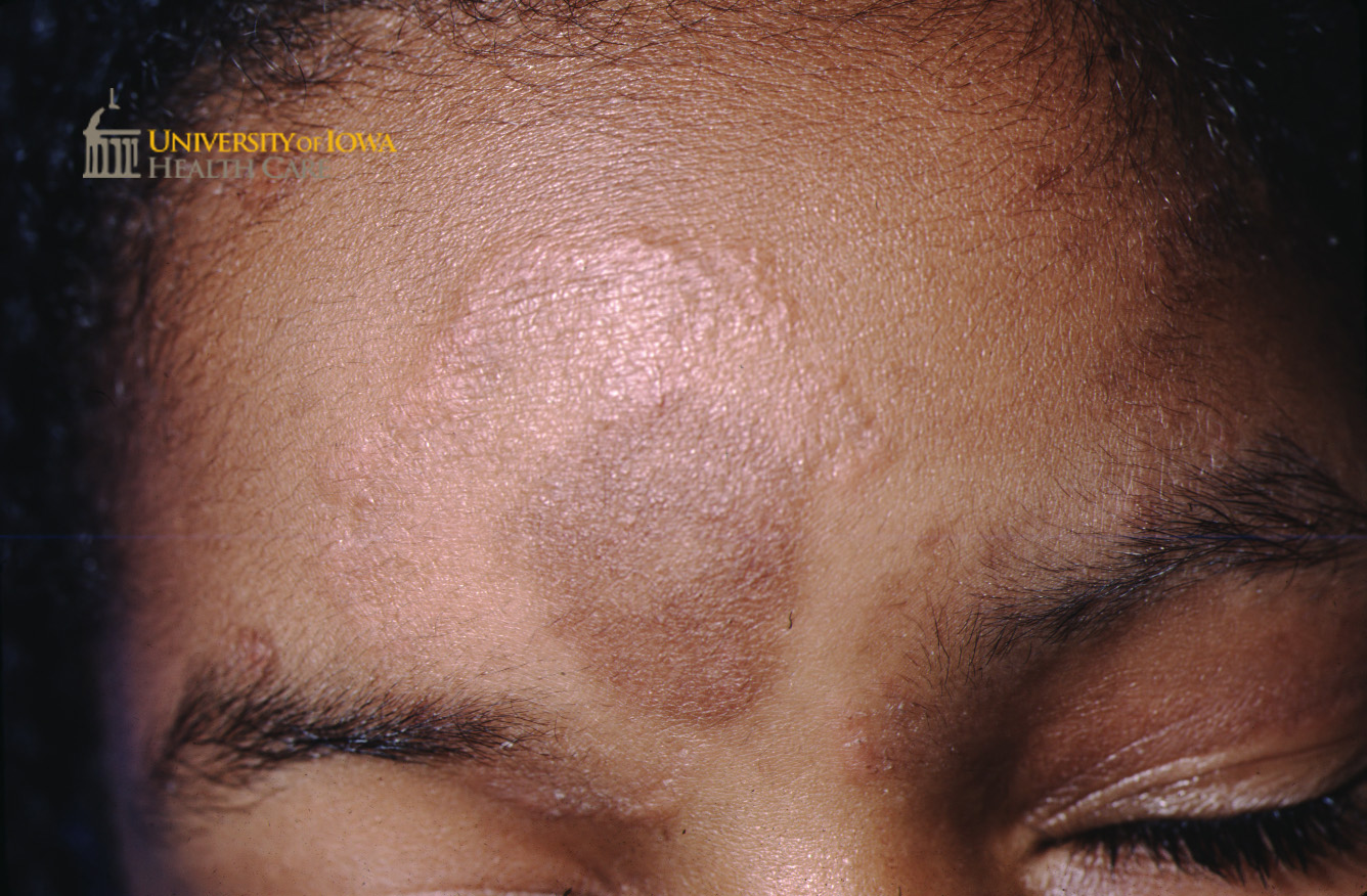 Edematous annular pink to hyperpigmented plaque on the forehead and eyelid. (click images for higher resolution).